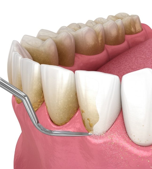 Animated smile during scaling and root planing gum disease treatment