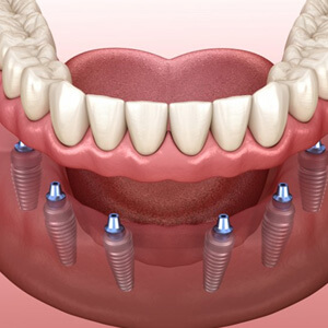 implant dentures