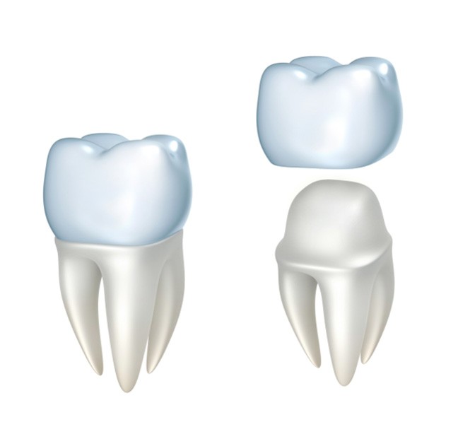 Model of how a dental crown works  