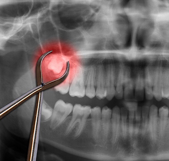 Grayscale X-ray image with impacted tooth highlighted red surrounded by forceps