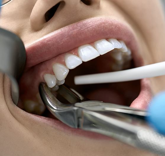 Closeup of someone’s tooth being grasped by forceps for an extraction