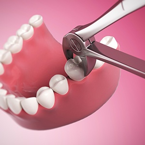 The location of the tooth could affect the cost of removing it