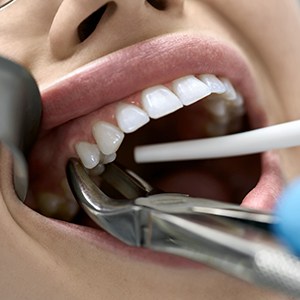 Dental insurance could offer partial coverage for your tooth extraction