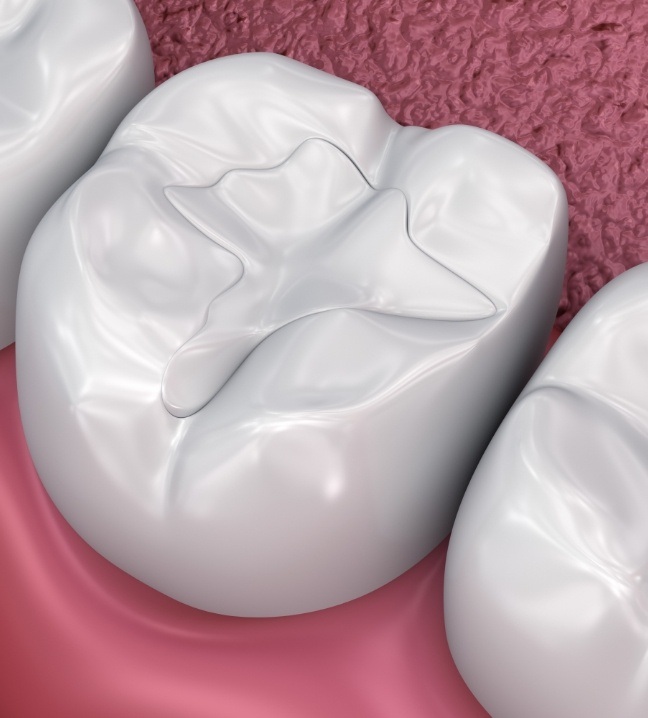 Animated smile with dental sealants being applied