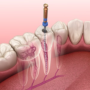 Digital illustration of a root canal