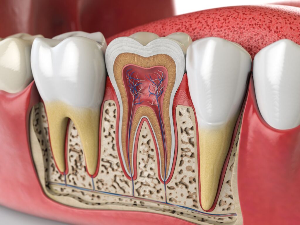 A computer-generated image of an infected tooth